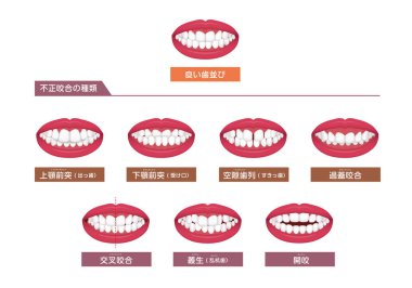Teeth trouble ( bite type / crooked teeth ) vector illustration set clipart