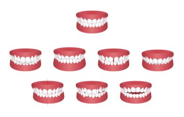 Teeth trouble ( bite type ) vector illustration set clipart