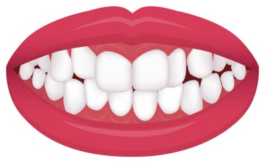 Teeth trouble ( bite type / crooked teeth ) vector illustration /Crowding clipart
