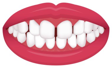 Diş sorunu (ısırık türü / çarpık dişler) vektör çizimi / Aşırı Boşluk