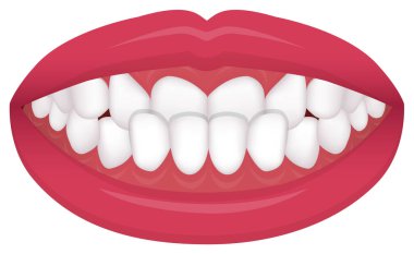 Teeth trouble ( bite type / crooked teeth ) vector illustration  /Underbite clipart