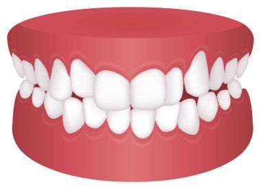 Teeth trouble ( bite type ) vector illustration /Crowding clipart