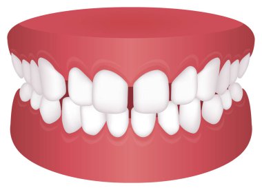 Teeth trouble ( bite type ) vector illustration / /Excessive Spacing clipart