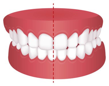 Teeth trouble ( bite type ) vector illustration /Crossbite (misalignment) clipart