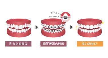 Diş telleri süreç vektör illüstrasyonu / Japonca