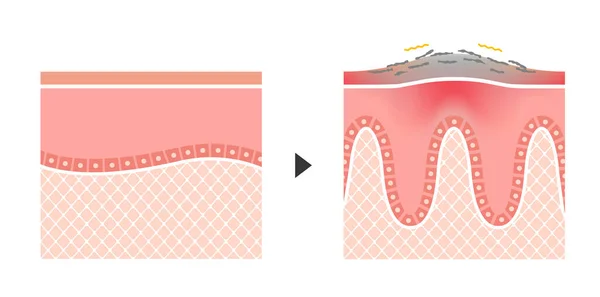 Cross Section Psoriasis Normal Skin Flat Vector Illustration — 图库矢量图片