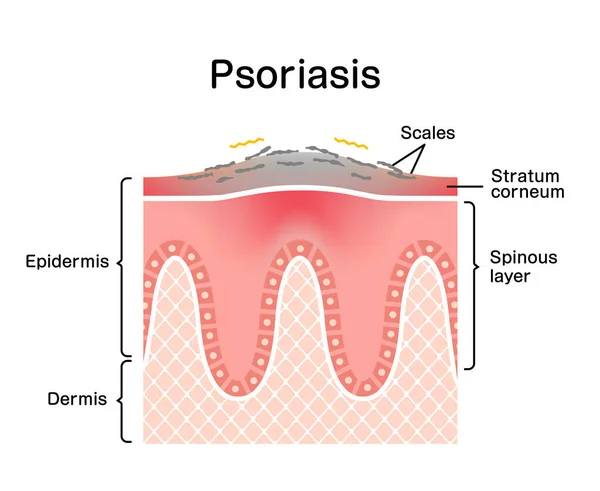 Sezione Trasversale Della Pelle Psoriasi Illustrazione Vettoriale Piatta — Vettoriale Stock