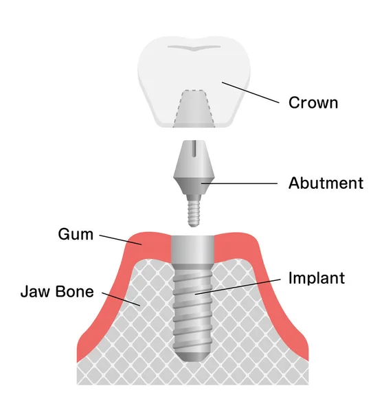 Ilustración Del Vector Plano Del Implante Dental — Archivo Imágenes Vectoriales