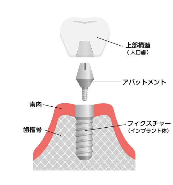 歯科インプラントフラットベクトル図 — ストックベクタ