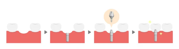 Processo Impianto Dentale Illustrazione Vettoriale Piatta Nessun Testo — Vettoriale Stock