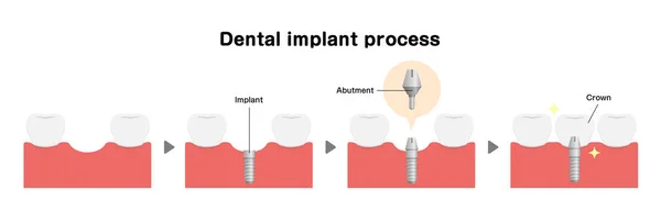 Dental Implant Process Flat Vector Illustration — Stockový vektor