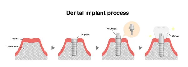 Ilustracja Wektora Płaskiego Procesu Implantacji Dentystycznej — Wektor stockowy