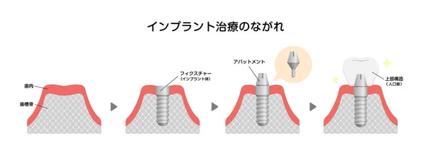 Οδοντιατρική Διαδικασία Εμφύτευσης Επίπεδη Διανυσματική Απεικόνιση Ιαπωνικά — Διανυσματικό Αρχείο