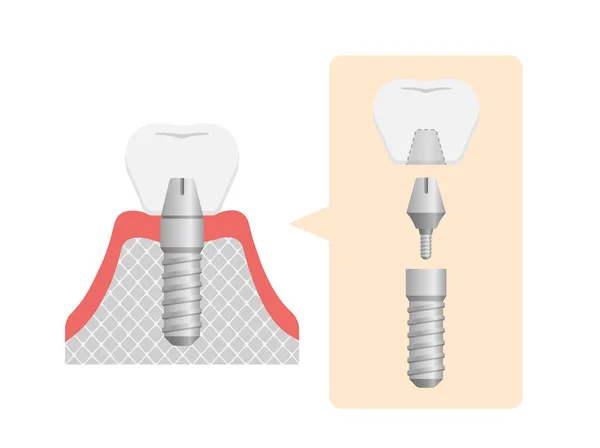 Fogászati Implantátum Lapos Vektor Illusztráció Nincs Szöveg — Stock Vector