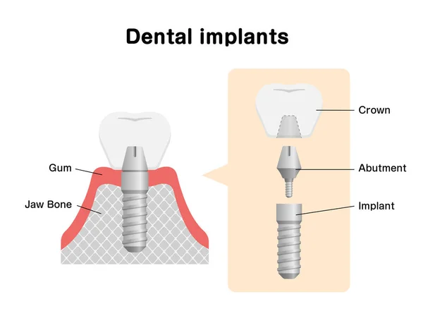 Ilustracja Wektora Płaskiego Implantu Dentystycznego — Wektor stockowy