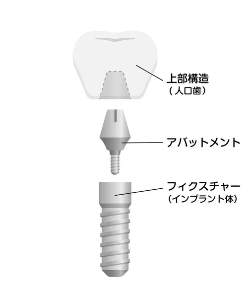 Ilustración Del Vector Plano Del Implante Dental Japonés — Vector de stock