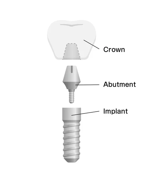 Ilustración Del Vector Plano Del Implante Dental — Vector de stock