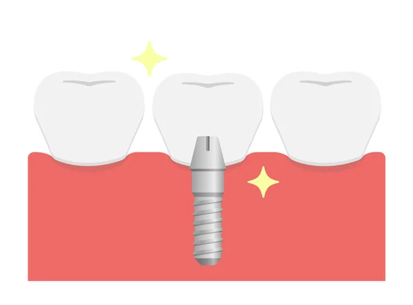 Implante Dental Vector Plano Ilustración Set Dientes Artificiales Corona — Vector de stock