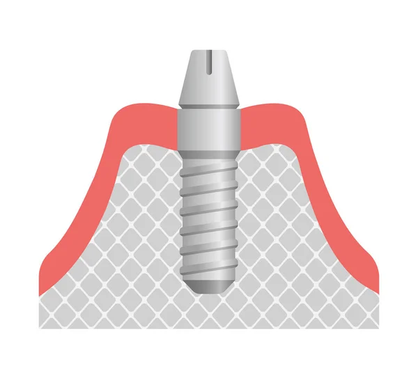 Зубний Імплант Плоский Векторні Ілюстрації Приєднати Абатмент — стоковий вектор