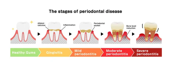 Las Etapas Enfermedad Periodontitis Vector Ilustración — Vector de stock