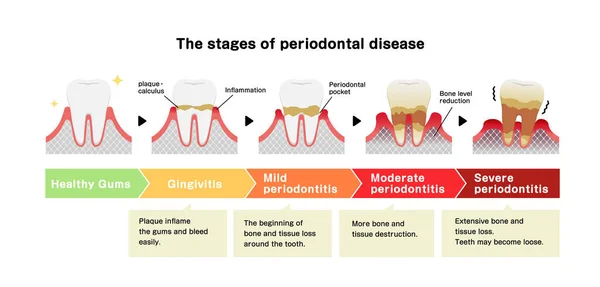 Las Etapas Enfermedad Periodontitis Vector Ilustración — Vector de stock