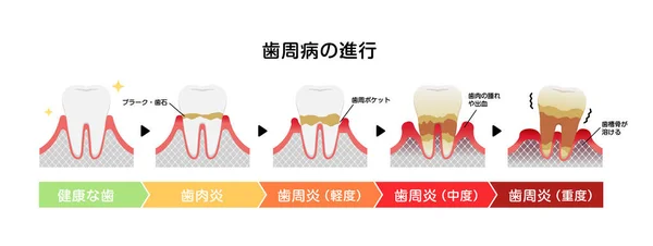 歯周炎の病期ベクトル図 — ストックベクタ