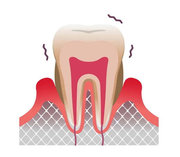 Illustration Vectorielle Plate Dent Gencive Maladie Parodontale — Image vectorielle