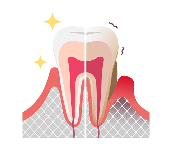 Comparaison Des Dents Normales Des Maladies Parodontales Illustration Vectorielle Plate — Image vectorielle