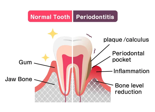 Comparison Normal Teeth Periodontal Disease Flat Vector Illustration — 스톡 벡터