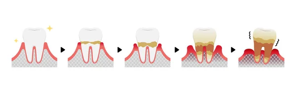 Етапи Захворювання Пародонтиту Векторні Ілюстрації — стоковий вектор