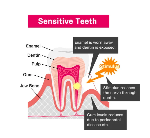 敏感な歯の原因とメカニズムベクトル図 — ストックベクタ