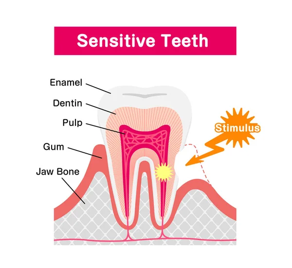 Causa Mecanismo Los Dientes Sensibles Vector Ilustración — Vector de stock