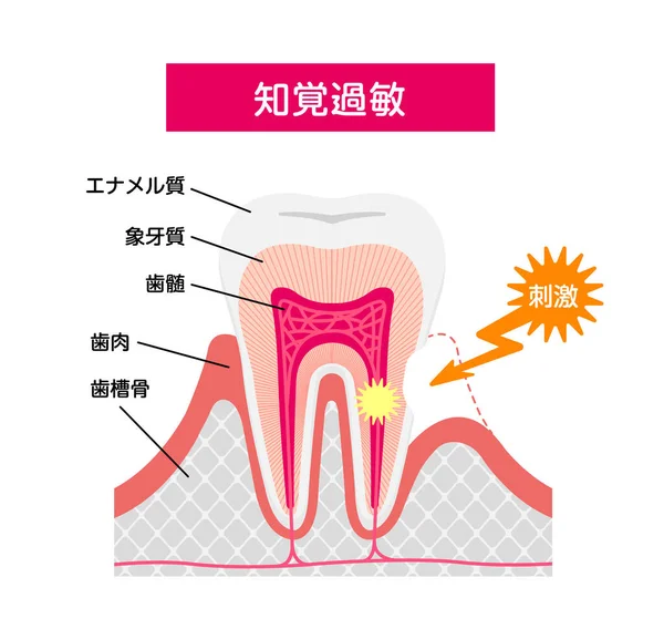 Причина Механізм Чутливих Зубів Векторна Ілюстрація Японська — стоковий вектор