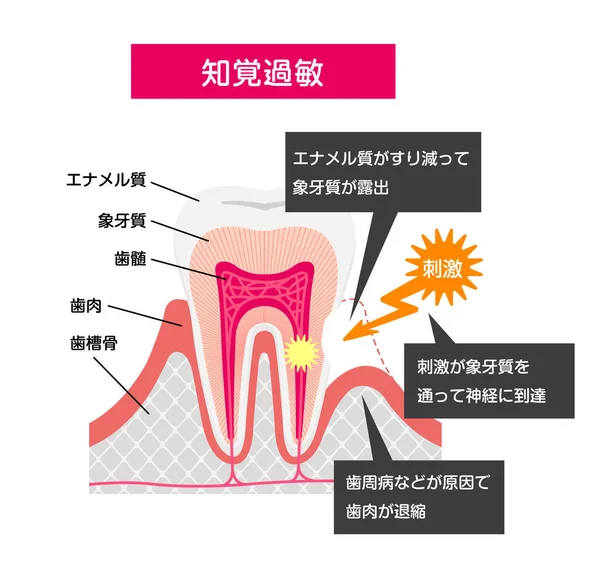 Ursache Und Mechanismus Der Empfindlichen Zähne Vektor Illustration Japanisch — Stockvektor