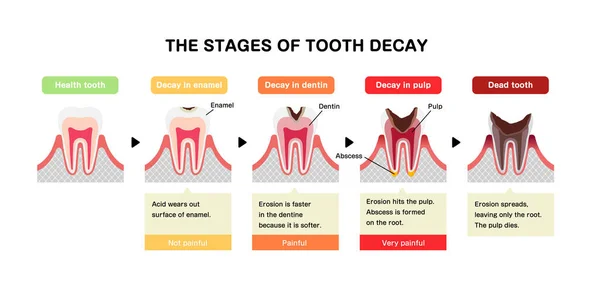 Las Etapas Caries Dental Ilustración Vectores Planos — Vector de stock