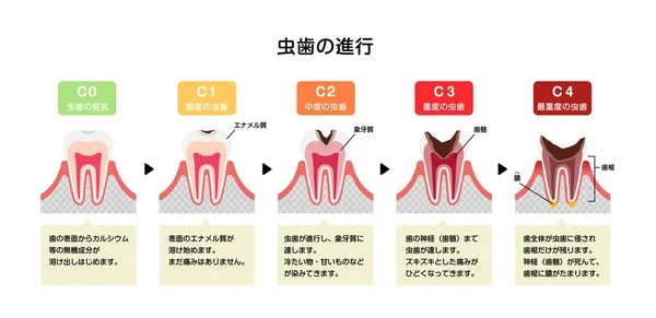 Estágios Cárie Dentária Ilustração Vetorial Plana Japonês —  Vetores de Stock