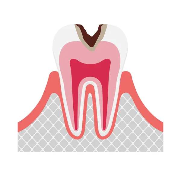 Этап Гниения Разложения Зубов Организме — стоковый вектор