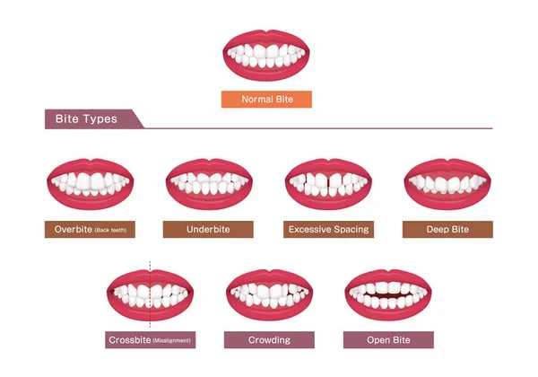 Δόντια Πρόβλημα Δάγκωμα Τύπου Στραβά Δόντια Διανυσματικό Σύνολο Εικονογράφησης — Διανυσματικό Αρχείο