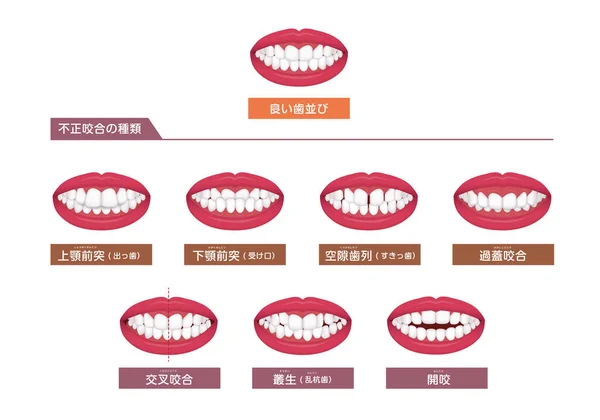 Δόντια Πρόβλημα Δάγκωμα Τύπου Στραβά Δόντια Διανυσματικό Σύνολο Εικονογράφησης — Διανυσματικό Αρχείο