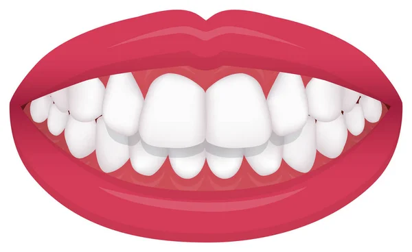 歯のトラブル 噛み型 曲がった歯 ベクトルイラスト Overbite 歯の裏 — ストックベクタ