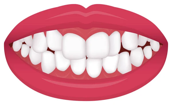 Problemas Com Dentes Tipo Mordida Dentes Tortos Ilustração Vetorial Aglomeração — Vetor de Stock