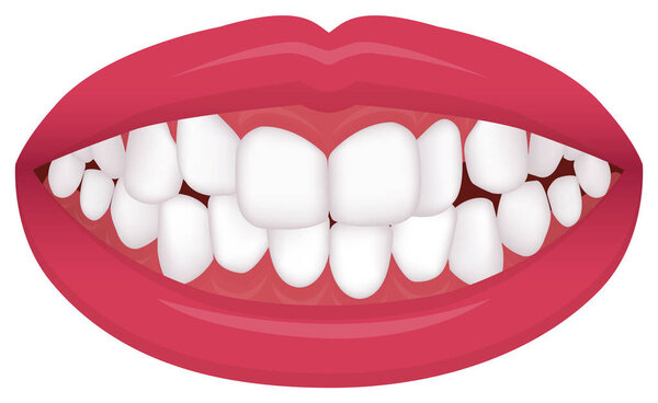 Teeth trouble ( bite type / crooked teeth ) vector illustration /Crowding