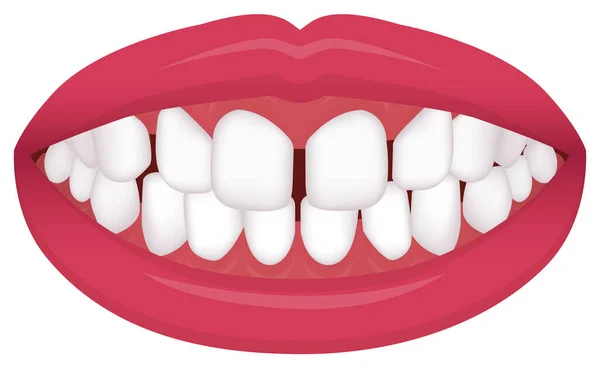 Problemas Dentales Tipo Mordida Dientes Torcidos Ilustración Vectorial Espaciado Excesivo — Archivo Imágenes Vectoriales