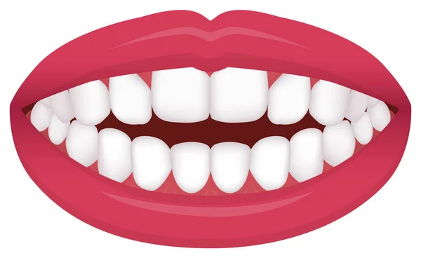 Teeth Trouble Bite Type Crooked Teeth Vector Illustration Open Bite — 스톡 벡터