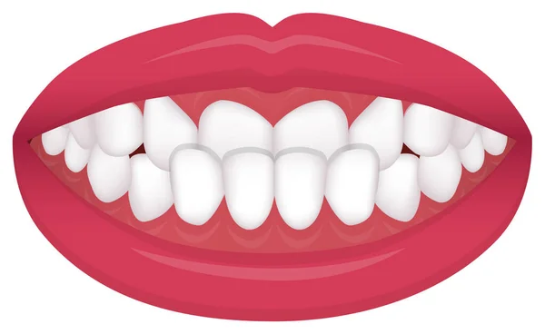 Problemas Dentales Tipo Mordida Dientes Torcidos Vector Ilustración Underbite — Archivo Imágenes Vectoriales