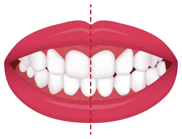 Problemas Dentales Tipo Mordida Dientes Torcidos Ilustración Vectorial Crossbite Desalineación — Archivo Imágenes Vectoriales