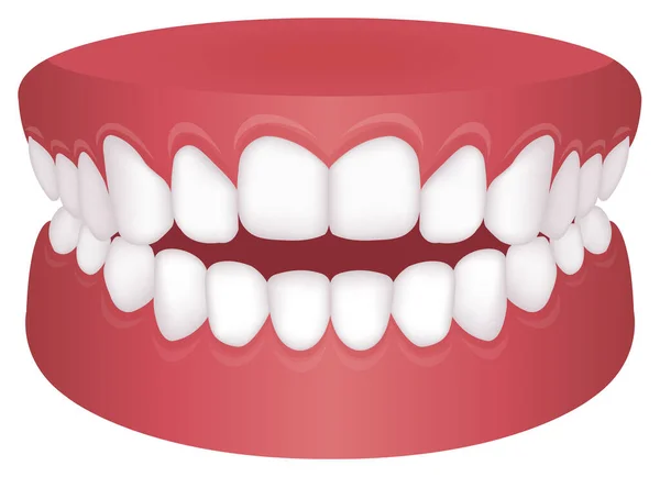 Dentes Problema Tipo Mordida Ilustração Vetorial Mordida Aberta —  Vetores de Stock