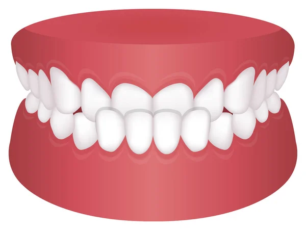 Teeth Trouble Bite Type Vector Illustration Underbite — Stock Vector