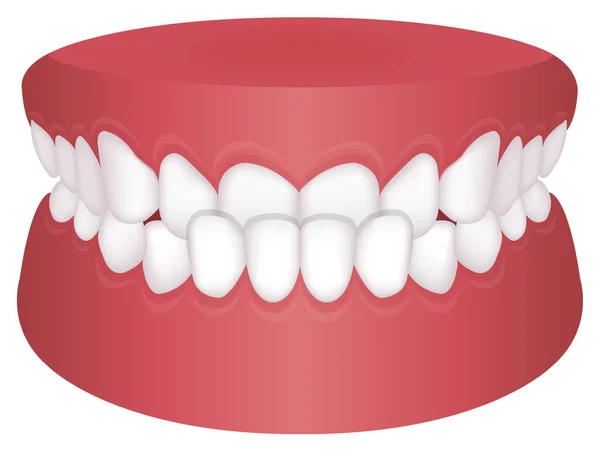 Problemen Met Tanden Type Beet Vectorillustratie Onderbeet — Stockvector