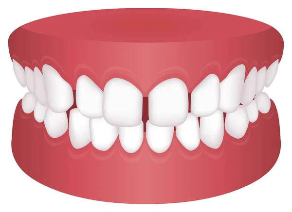 Problemi Denti Tipo Morso Illustrazione Vettoriale Distacco Eccessivo — Vettoriale Stock